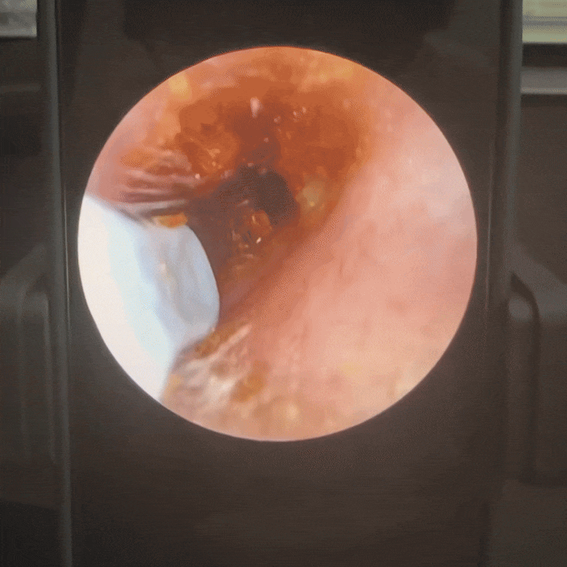 Smart Visual Ear Cleaner : Doctor Approved Ear Health Technology