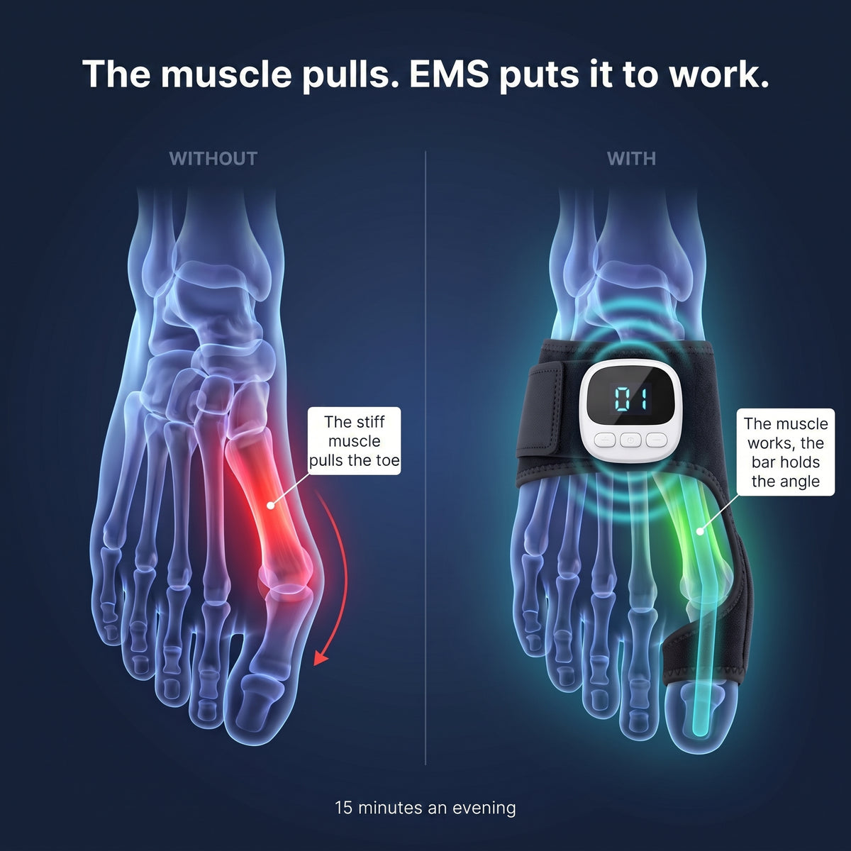 AVORE Pro EMS Bunion Corrector